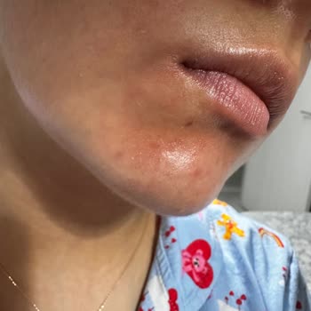 Kurtsan İlaçları Ciltte Yanma Kızarıklık