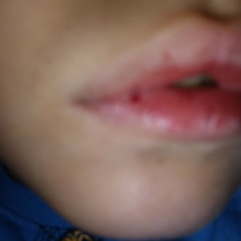 Nivea Dudak Nemlendirici Yara Yapması