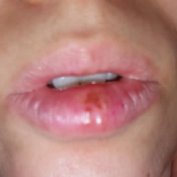 Nivea Dudak Nemlendirici Yara Yapması