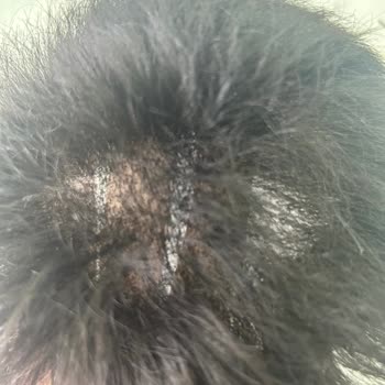 Hair Life Protez Saç Hüsranı: Kalitesiz Ürün Ve Hizmet