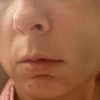 Optimum Dental Ağız ve Diş Sağlığı Merkezi Optimum Dental Aydında Yaşadığım Diş Travması