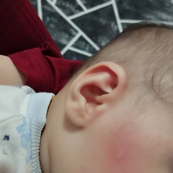 Bebelac Kullanımında Bebeğimde Kızarıklık Sorunu