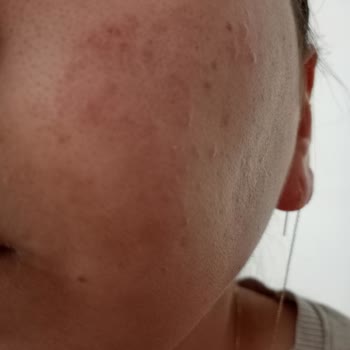 Procsin Ürünleri Yüzünden Yüzüm Mahvoldu Üstelik İlgilenmediler Bile