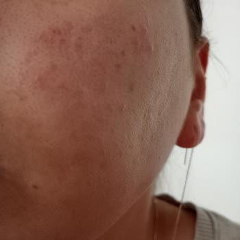 Procsin Ürünleri Yüzünden Yüzüm Mahvoldu Üstelik İlgilenmediler Bile