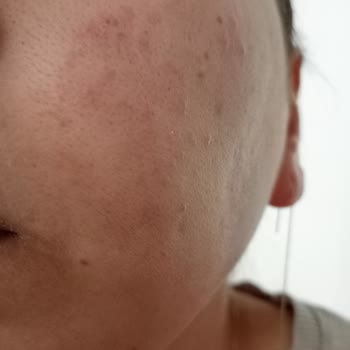 Procsin Ürünleri Yüzünden Yüzüm Mahvoldu Üstelik İlgilenmediler Bile