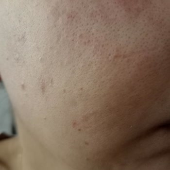 Procsin Ürünleri Yüzünden Yüzüm Mahvoldu Üstelik İlgilenmediler Bile