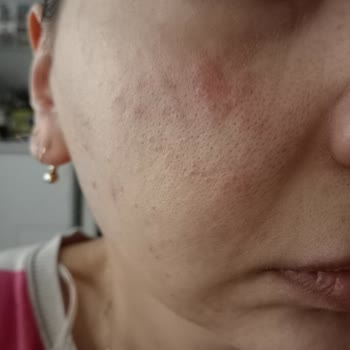 Procsin Ürünleri Yüzünden Yüzüm Mahvoldu Üstelik İlgilenmediler Bile