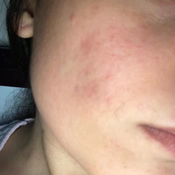 Note Cosmetics Note Luminous Sivilce Yaptı