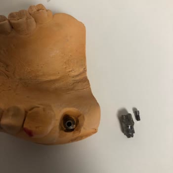 DentaCenter Orijinalliği Şüpheli İmplant Parçası Kullanıp Beni Mağdur Ettiler