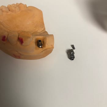DentaCenter Orijinalliği Şüpheli İmplant Parçası Kullanıp Beni Mağdur Ettiler