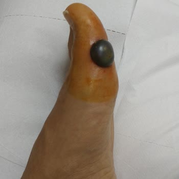 Özel Gaziemir Cerrahi Tıp Merkezi Kriyoterapi Uygulama Sonrası ☹️