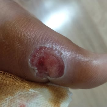 Özel Gaziemir Cerrahi Tıp Merkezi Kriyoterapi Uygulama Sonrası ☹️