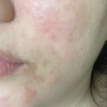 Yves Rocher Pure Menthe Yüz Temizleme Misel Su Cildimi Mahvetti