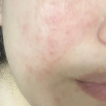 Yves Rocher Pure Menthe Yüz Temizleme Misel Su Cildimi Mahvetti