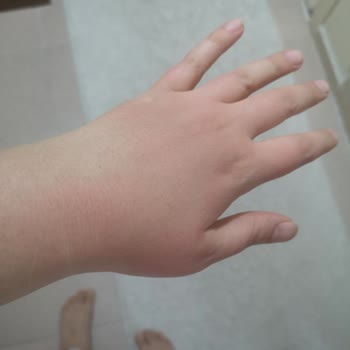 Bepanthol Sensiderm Egzamalı Ciltler İçin Krem Yanma ve Kaşınma Yaptı