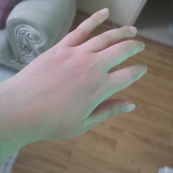 Bepanthol Sensiderm Egzamalı Ciltler İçin Krem Yanma ve Kaşınma Yaptı