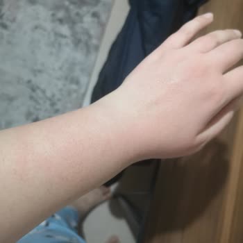 Bepanthol Sensiderm Egzamalı Ciltler İçin Krem Yanma ve Kaşınma Yaptı