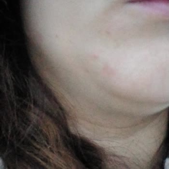 Bioderma Yüz Jeli Alerjisi