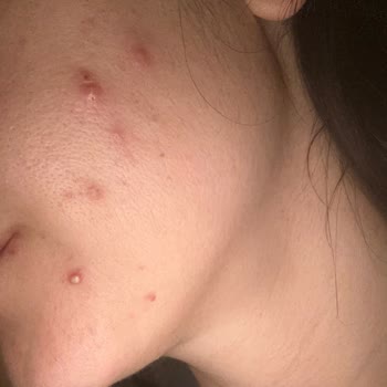 Estee Lauder İle Çıkan Sivilceler