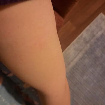 Avon Şampuan Kaşıntı Ve Döküntü