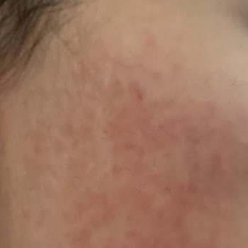 Maruderm Gözenek Arındırıcı Tonik