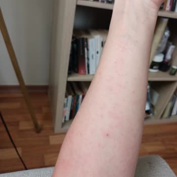 Yves Rocher Duş Jeli Kullanımı Sonrası Alerjik Reaksiyon Ve Kaşıntı Şikayeti