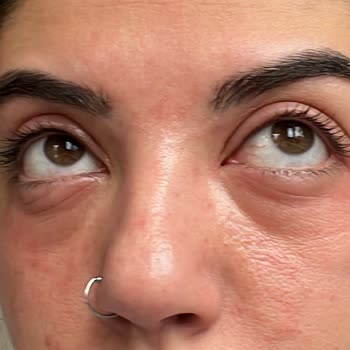 Pastel Kozmetik Pastel Kapatıcı Alerjisi