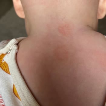 Mustela Ürünleri Alerji Yapıyor