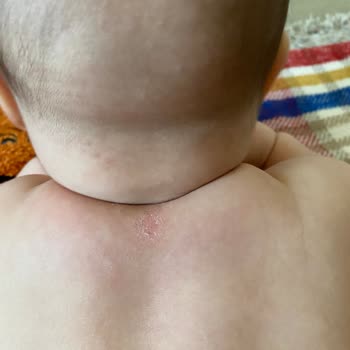 Mustela Ürünleri Alerji Yapıyor
