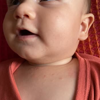 Mustela Ürünleri Alerji Yapıyor