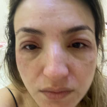 Trendyol Sahte Ürün, Alerjik Reaksiyon, Kalıcı Hasar