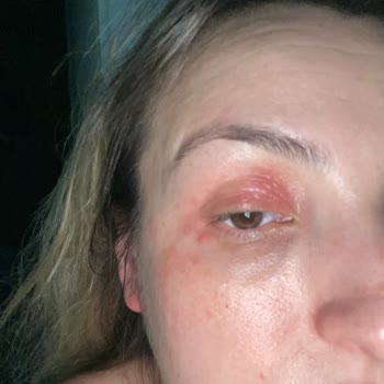 Trendyol Sahte Ürün, Alerjik Reaksiyon, Kalıcı Hasar