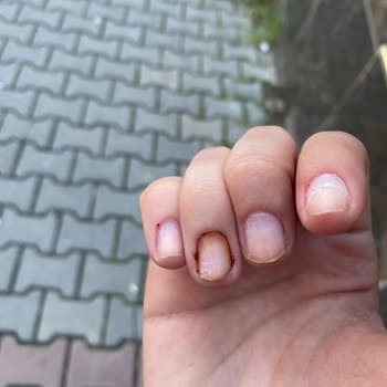 Aymira Koçaklı Yaşam Merkezi Protez Tırnak Pişmanlığım