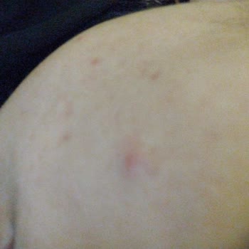 Neutrogena Yüzümde Sivilce Oluşturdu