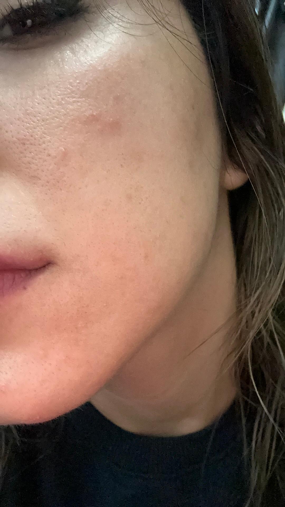 Loreal Paris Retinol Hyaluronik Asid Serum Şikayetvar