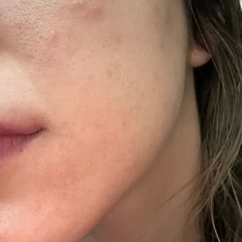 Loreal Paris Retinol - Hyaluronik Asid Serum