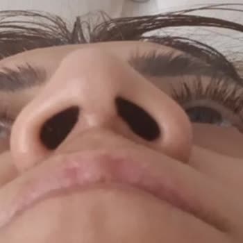 Özel Ekol Hastanesi (İzmir) Burun Ameliyat Mağduriyeti