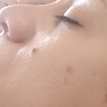 Özel Ekol Hastanesi (İzmir) Burun Ameliyat Mağduriyeti