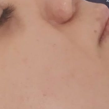 Özel Ekol Hastanesi (İzmir) Burun Ameliyat Mağduriyeti