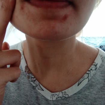 Nivea Ürünleri Yüzümde Sivilceleri Artırdı