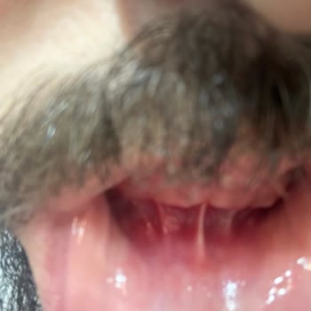 Parodontax Ağzımın İçinde Yaklaşık 10 Tane Aft Var