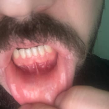 Parodontax Ağzımın İçinde Yaklaşık 10 Tane Aft Var