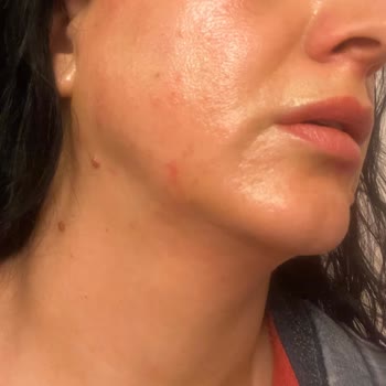 Trendyol Epilasyon Kremi Kullanımı Sonrası Yaşanan Cilt Problemleri