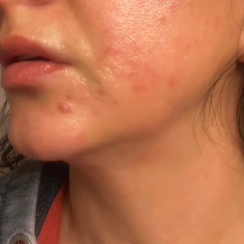 Trendyol Epilasyon Kremi Kullanımı Sonrası Yaşanan Cilt Problemleri