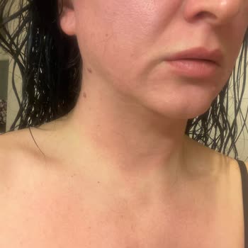 Trendyol Epilasyon Kremi Kullanımı Sonrası Yaşanan Cilt Problemleri