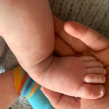 Organik Olduğunu İddia Eden Hipp'in Bebeğimde Sebep Olduğu Ürtiker!