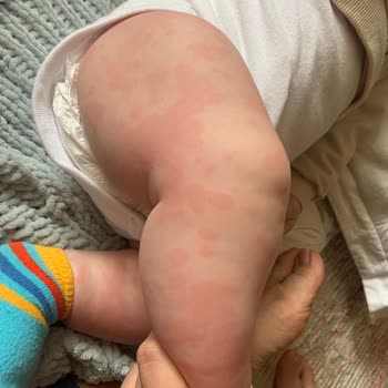 Organik Olduğunu İddia Eden Hipp'in Bebeğimde Sebep Olduğu Ürtiker!