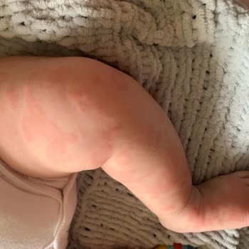 Organik Olduğunu İddia Eden Hipp'in Bebeğimde Sebep Olduğu Ürtiker!