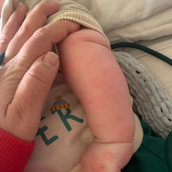 Organik Olduğunu İddia Eden Hipp'in Bebeğimde Sebep Olduğu Ürtiker!