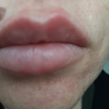 Procsin 3 Complex Solution Cildimi Mahvetti.